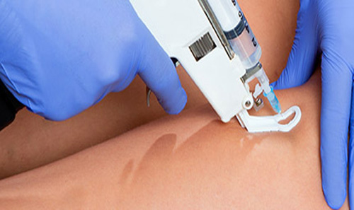mesotherapy